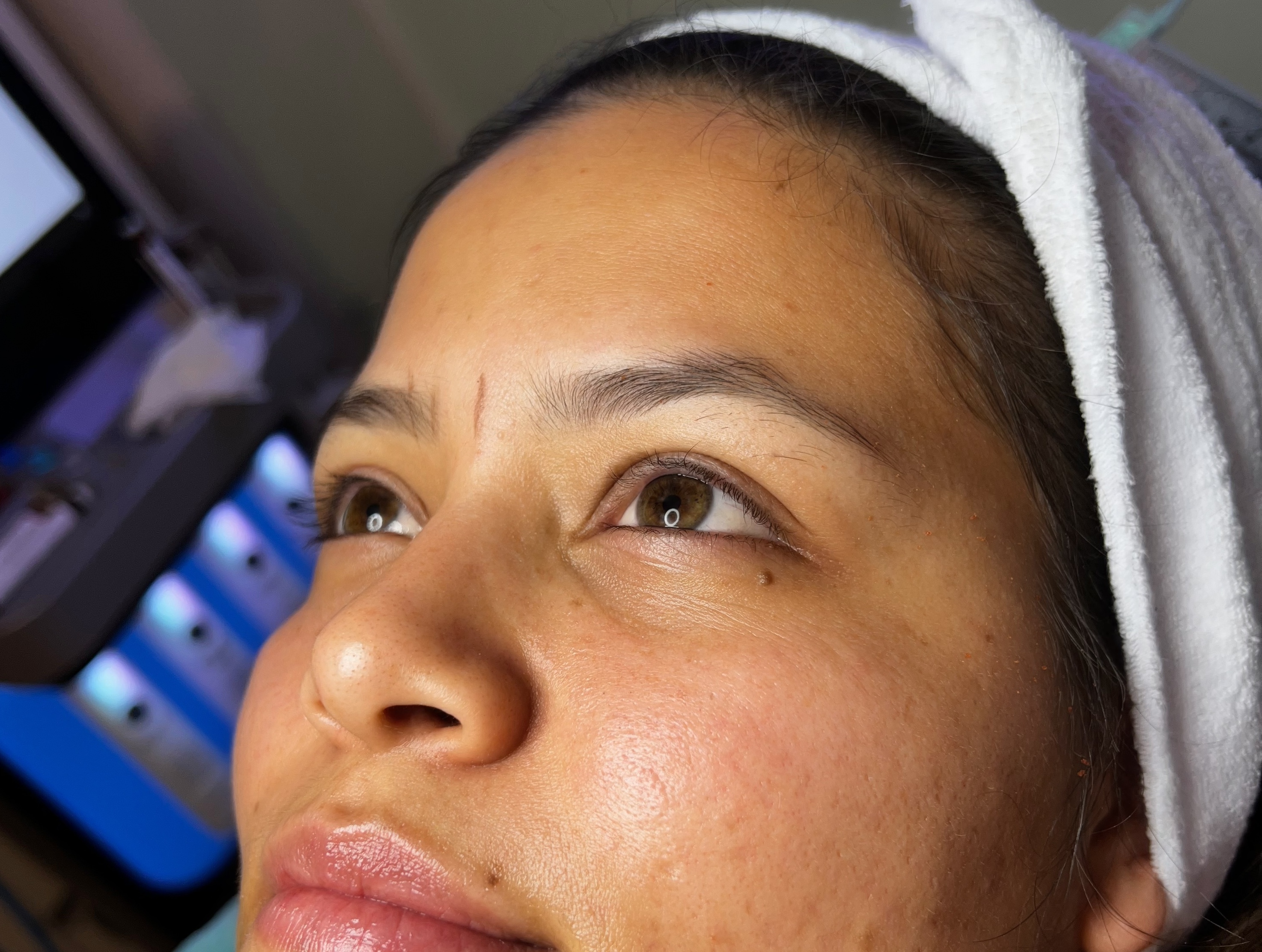 Before Microblading - Case 1